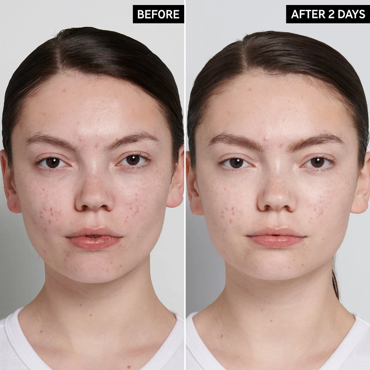 The INKEY List Succinic acid acne treatment Skin Care Volare Makeup   